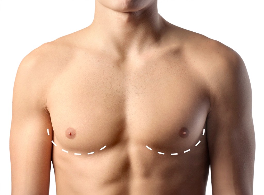 Gynécomastie