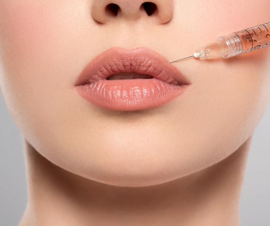 Injection d'acide hyaluronique — comblement des lèvres