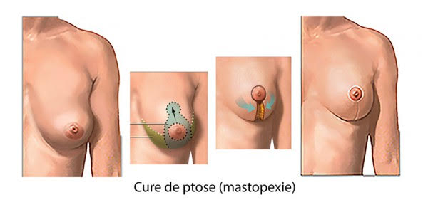 Illustration médicale des étapes d'une cure de ptose mammaire (mastopexie) montrant le repositionnement du sein.