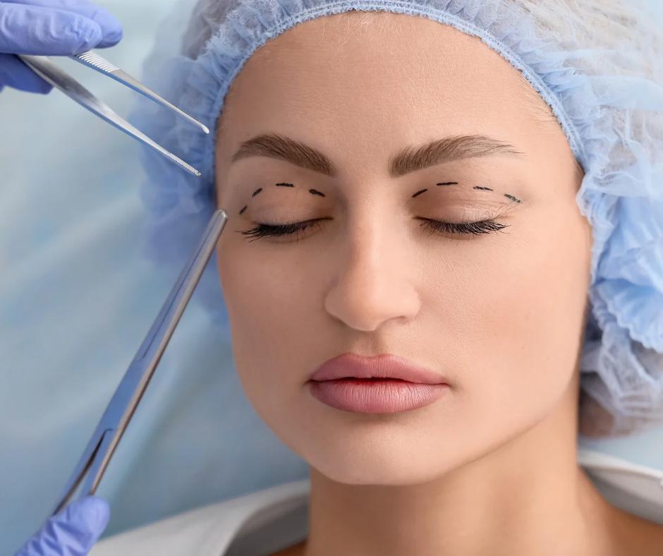 Blépharoplastie résultat